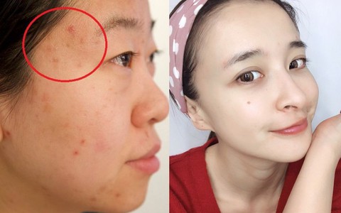Nhan sắc sẽ tụt hạng nếu mụn quanh trán hoành hành, và đây là 4 nguyên nhân cùng giải pháp xử đẹp tình trạng này