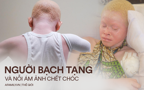 Nỗi bất hạnh của người bạch tạng ở lục địa đen: Bị săn lùng như động vật quý hiếm, đến trẻ nhỏ cũng bị cắt cụt tứ chi vì cuồng tín mê muội