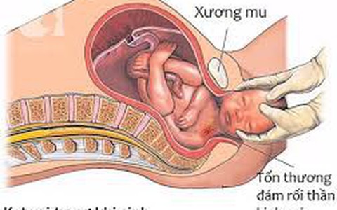 Sinh khó do kẹt vai - Tai biến sản khoa đáng sợ và bi thảm nhất