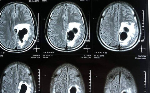Ăn tiết canh, một người nhập viện do sán làm tổ trong não