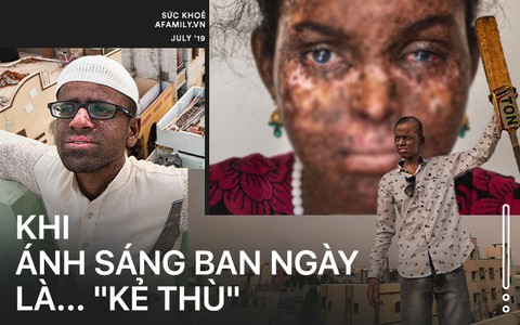 Hậu quả từ các cuộc hôn nhân cận huyết: Những đứa trẻ đang chết dần chết mòn bởi… ánh nắng mặt trời