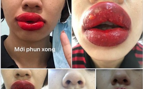 Cô gái bị sưng tều môi, nổi mụn nước sau khi làm ở spa gần nhà, chuyên gia đưa ra lời cảnh báo chị em nào cũng phải biết