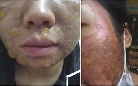 Chăm sóc da mặt theo những cách này, nhiều chị em khóc nghẹn vì da đóng vảy, sần sùi khó phục hồi