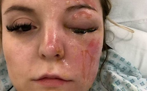 Dùng lò vi sóng luộc trứng cô gái bị bỏng kinh hoàng: Chuyên gia lưu ý khi nấu ăn bằng lò vi sóng cần chú ý những điều sau!