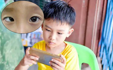 Dán mắt vào điện thoại nhiều giờ liền, cậu bé 9 tuổi đột nhiên bị lác mắt chỉ sau một kì nghỉ hè