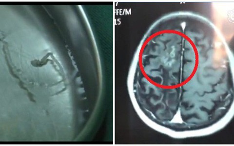 Người đàn ông bị đau đầu suốt 30 năm do kí sinh trùng 10cm sống trong não, bác sĩ lấy ra ngoài vẫn ra sức ngọ nguậy