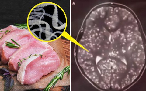 Thanh niên 18 tuổi có sán làm tổ trong não sau khi ăn một món cả triệu người thích 