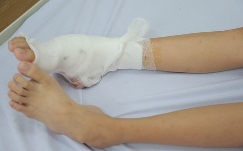 Phẫu thuật thành công cho bệnh nhi 14 tuổi có dáng đi bất thường do bị biến dạng ở cổ bàn chân hiếm gặp