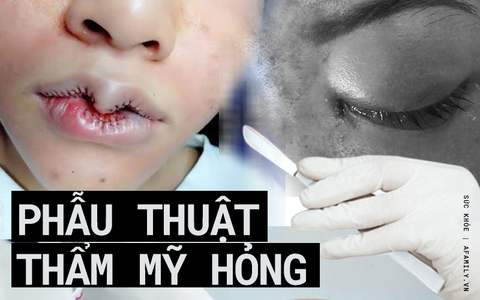 Những ca phẫu thuật thẩm mỹ hỏng đầy kinh hãi, chị em đang nung nấu làm hãy cân nhắc!