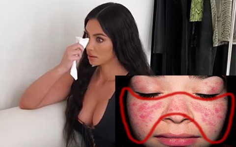 Mắc bệnh lupus ban đỏ như Kim Kardashian nguy hiểm thế nào?