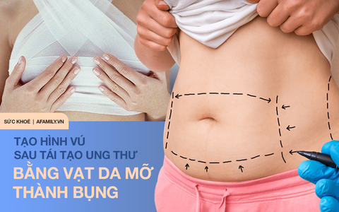 Phẫu thuật tạo hình vú giúp bệnh nhân ung thư nhanh chóng lấy lại tự tin, góp phần điều trị toàn diện cho bệnh nhân ung thư vú