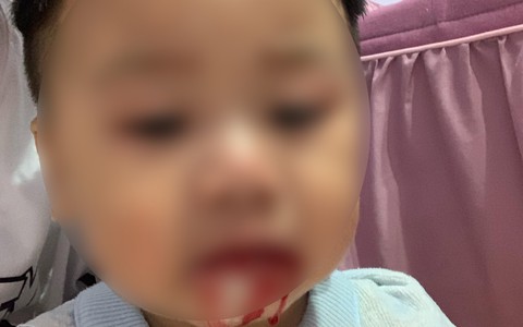 Bé trai chảy máu miệng, "mất" hết răng vì nhiễm khuẩn từ hành vi vô ý của người lớn