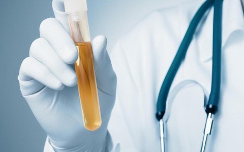 Đổi màu nước tiểu, phát hiện 1 loại ung thư cực chính xác