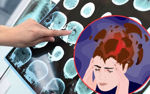 Trong dịp Tết, 2 bệnh "chết người" này gia tăng mạnh: Nghe bác sĩ BV Việt Đức chỉ cách dự phòng và phát hiện sớm