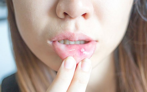 Tết ăn đồ cay nóng bị nhiệt miệng, nghĩ là bệnh không nghiêm trọng nhưng chữa mãi không hết, đó có thể là dấu hiệu của ung thư