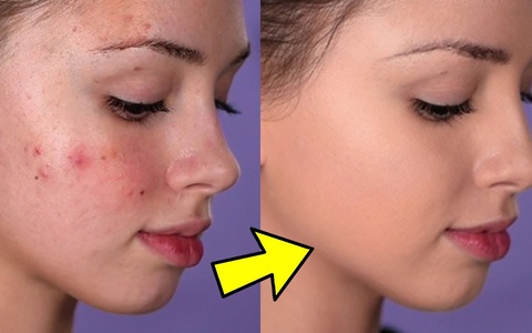 Tết đến mụn chưa kịp hết thì cũng đừng hoảng, chị em đã có tuyệt chiêu makeup giấu tiệt mụn, phù phép cho da không tỳ vết rồi!