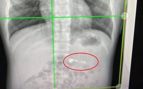 Tặng con món quà là tai nghe không dây, ít ngày sau mẹ thấy chiếc tai nghe nằm yên vị trong... dạ dày con