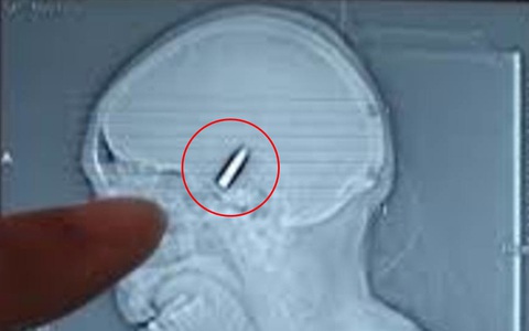 Bị đánh thức bởi cơn đau đầu dữ dội, người đàn ông đến bệnh viện mới biết mình bị vợ dùng súng bắn vào đầu