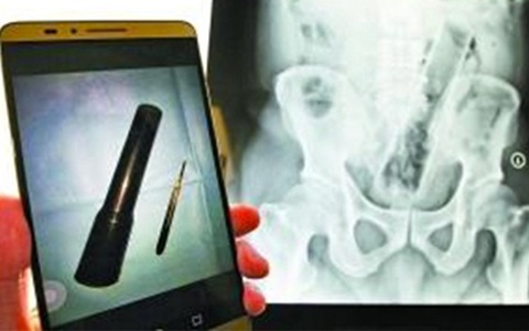Vật vã phẫu thuật 2 tiếng đồng hồ để lấy... đèn pin ra khỏi bụng