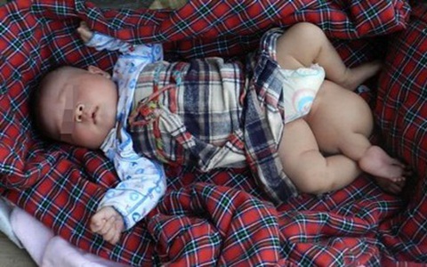 Bé gái sơ sinh 3 chân suýt bị mẹ bỏ rơi