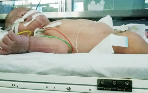 Hòa Bình: Cháu bé 22 ngày tuổi tử vong sau mũi tiêm phòng lao