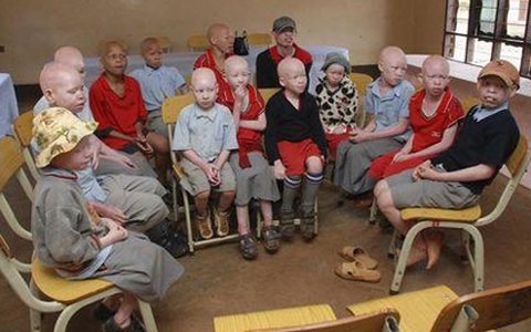 Tanzania: Tính mạng trẻ em mắc bệnh bạch tạng bị đe dọa vì sự cuồng tín