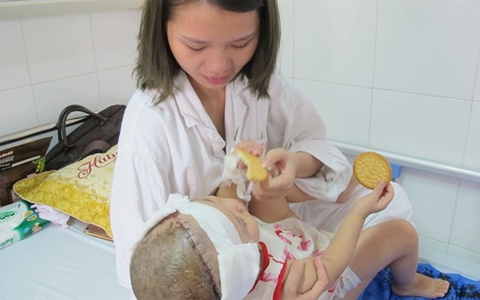 Ca ghép nối da đầu cho bé gái 2 tuổi đầu tiên tại Việt Nam