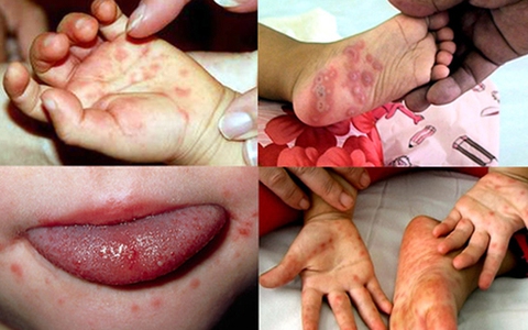 Những điều cha mẹ nào cũng nên biết khi bệnh tay chân miệng đang có dấu hiệu bùng phát