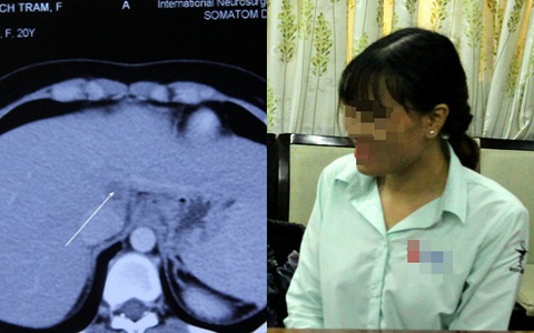 Điều trị thành công ca bệnh hiếm gặp đầu tiên ở Việt Nam và thứ 2 trên thế giới