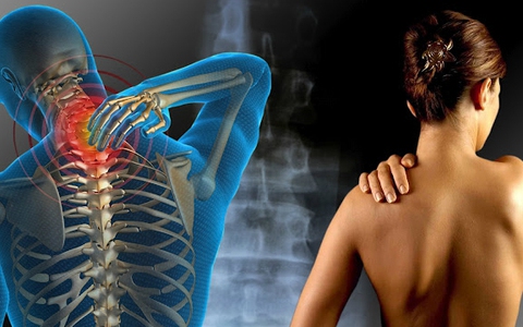 Hội chứng đau cơ này nguy hiểm nhưng lại thường xuyên bị mọi người bỏ qua