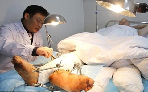Người đàn ông có tới hai "bàn chân phải"