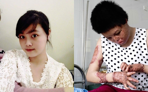 Cô gái 22 tuổi xấu số bị chồng thiêu sống đến dị dạng: "Tôi đã dám nhìn mình trong gương và không trốn tránh nữa"