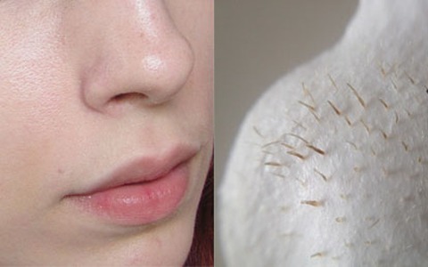 Những nốt li ti trên mũi: Tưởng mụn đầu đen mà không phải!