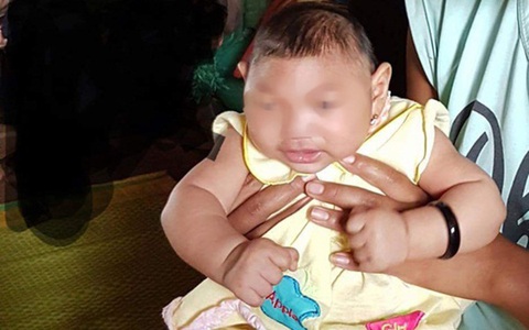 2 bé mắc chứng đầu nhỏ ở Đắk Lắk không phải do Zika
