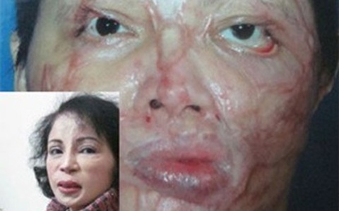 Người phụ nữ Hà Nội 41 lần phẫu thuật làm đẹp