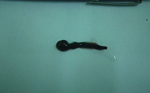 Hãi hùng con sên dài 3cm chui vào mũi em bé