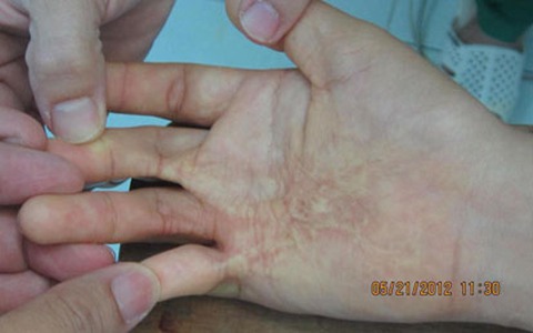 Phòng tránh di chứng bỏng gây sẹo co rút bàn tay ở trẻ em