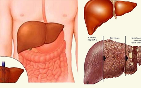 Viêm gan tối cấp: căn bệnh đặc biệt nguy hiểm