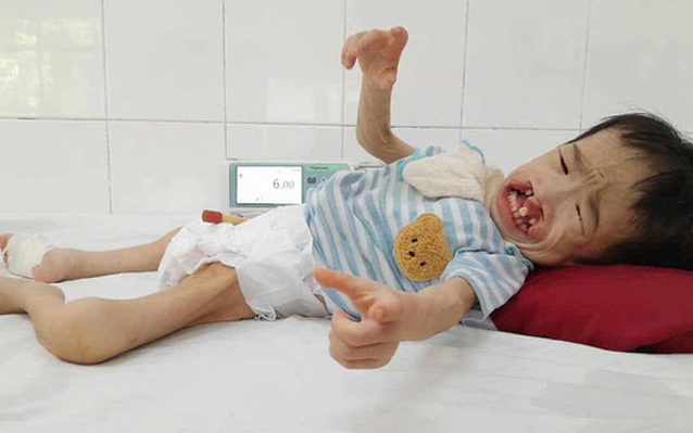 Bé gái 3 tuổi có khuôn mặt biến dạng vì dị tật mong chờ cơ hội được phẫu thuật