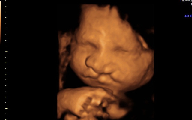 Siêu âm 4D là phương pháp mà các bà mẹ có thể nhìn thấy mặt thai của bé và các chi tiết như đôi chân, tay, phần cơ thể... với độ nét cao, giúp tạo nên những khoảnh khắc đáng nhớ trong quá trình mang thai.