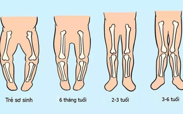 Nhận Biết Chính Xác Trẻ Có Mắc Tật Chân Vòng Kiềng Hay Không Và Cách Phòng  Tránh Hiệu Quả