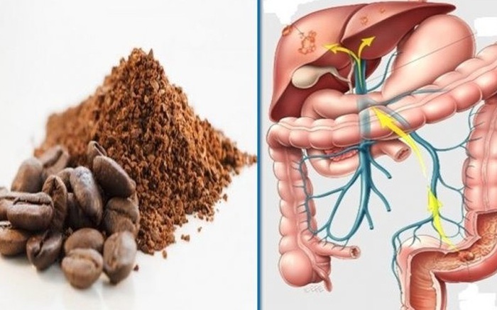 Thụt trực tràng - coffee enamas là phương pháp giúp nhuận tràng hiệu quả. Thụt trực tràng - coffee enamas là phương pháp giúp nhuận tràng hiệu quả.