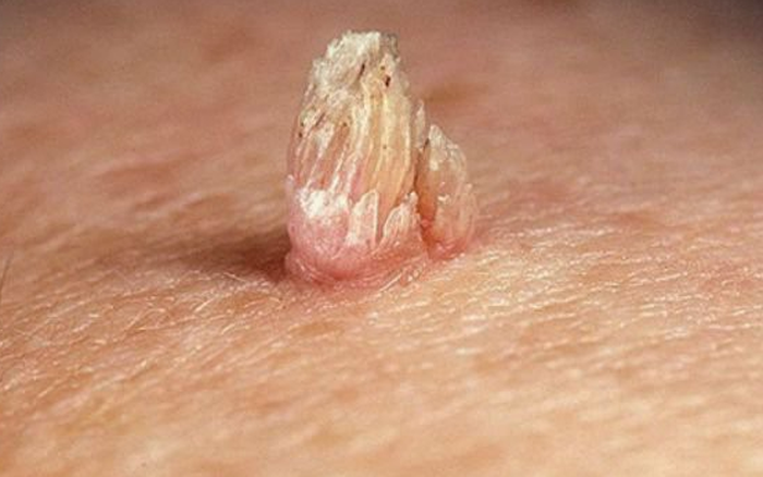 Cách chữa sùi mào gà hiệu quả tại nhà triệt để