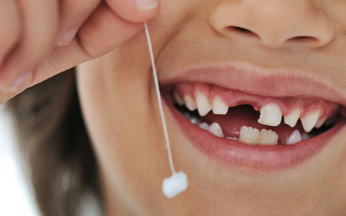 Khi trẻ bị gãy răng, đừng vội vứt đi, việc đơn giản này có thể giúp nối lại  răng