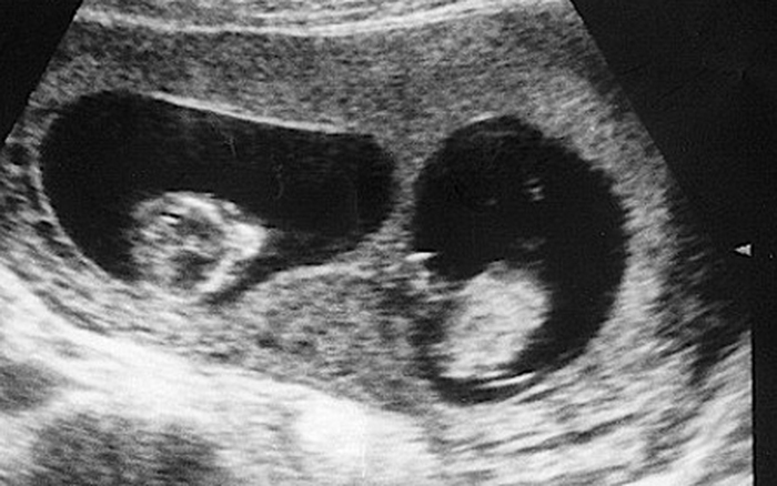 Siêu âm thai đôi: Bạn đang mang thai đôi và muốn biết cả hai bé của mình đang phát triển như thế nào? Siêu âm thai đôi là giải pháp chính xác để thăm khám sức khỏe của bé. Hãy xem hình ảnh siêu âm để thấy rõ hơn nét đặc trưng của mỗi bé.